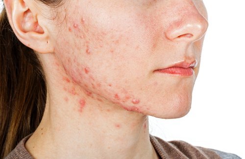 Acne sul viso