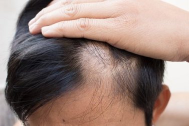 6 rimedi naturali contro la calvizie