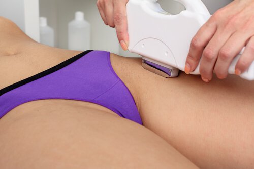 Depilazione laser