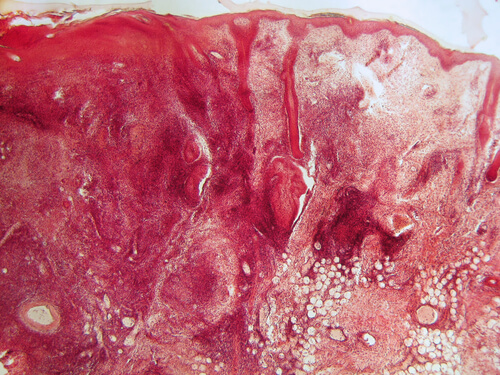 Patogenesi lupus