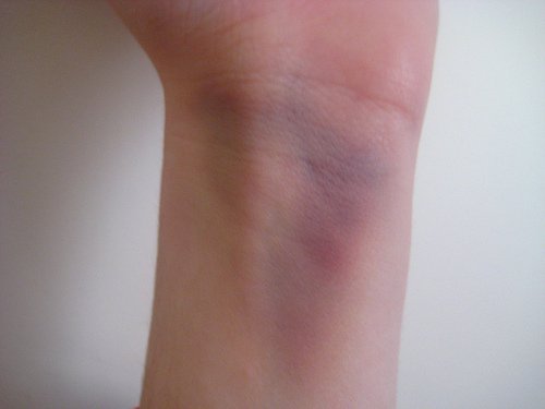 Livido sul polso