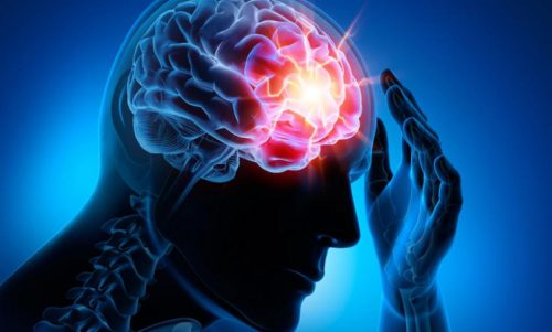 Le 4 malattie cerebrovascolari più comuni