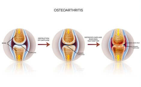 Sviluppo dell'osteoartrite.