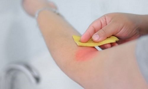 Buccia di banana per le punture di insetto