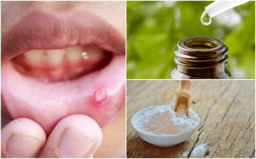 Attenuare le afte della bocca con 6 rimedi naturali