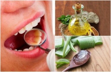 Come rimuovere il tartaro dai denti in modo naturale