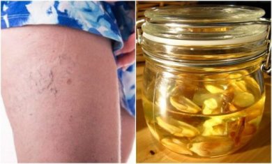 Come preparare un unguento per i capillari rotti