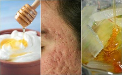 5 maschere naturali per attenuare i segni dell'acne