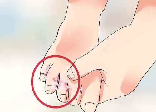 Piede d’atleta: 7 rimedi naturali Piede d’atleta: 7 rimedi naturali