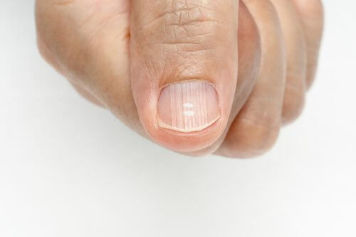 Righe sulle unghie: cause e rimedi