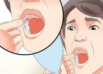 Dente del giudizio: ridurre il gonfiore dopo l'estrazione