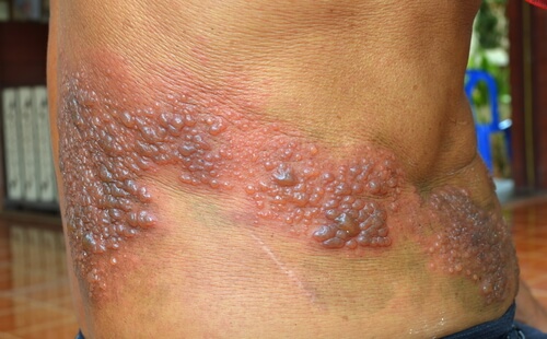Eruzione da herpes zoster lungo il nervo
