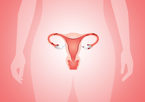 Fibromi e polipi dell'utero possono provocare sanguinamenti vaginali