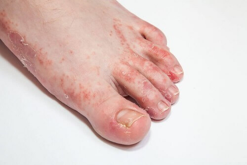 Infezione al piede