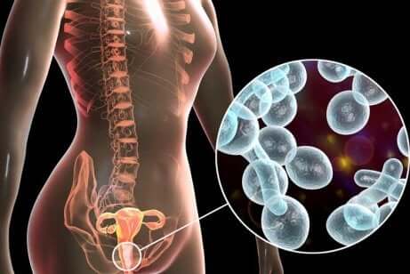 Vulvite: infezione vaginale da lievito.