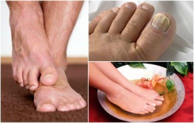 Come identificare le micosi dei piedi