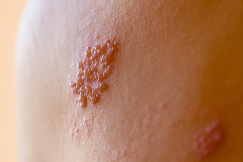 Sfogo da herpes zoster