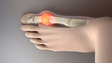 8 alimenti per ridurre i livelli di acido urico