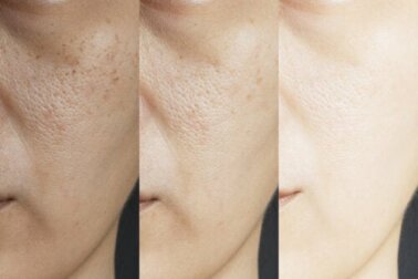 Restringere i pori dilatati con 8 rimedi naturali