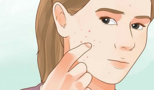 Ragazza con l'acne