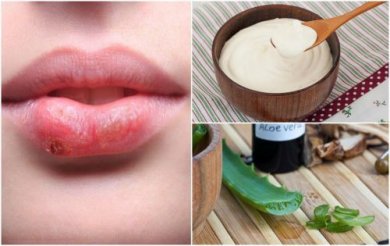 Combattere l'herpes labiale con 7 trattamenti naturali