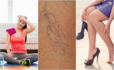 8 modi per prevenire la formazione delle teleangectasie