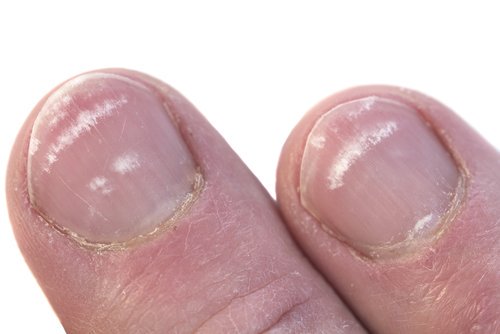 Macchie bianche su unghie delle mani