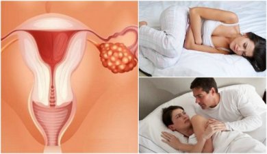 Cancro alle ovaie: 7 importanti sintomi da conoscere