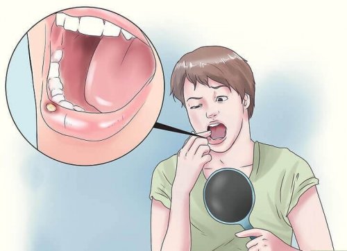 Ulcere della bocca: 8 rimedi naturali