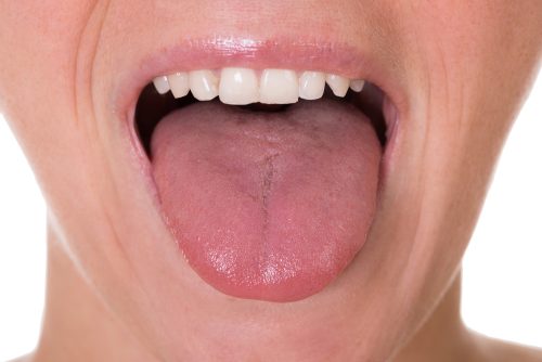 papilloma lingua sintomi