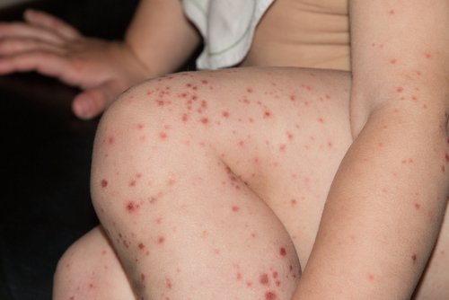 Bambino con macchie causate dal virus Coxsackie.