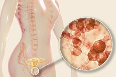 Candidosi genitale femminile: cause, sintomi e trattamento