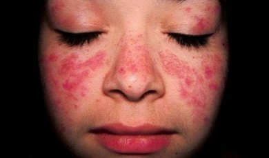 Trattamento del lupus eritematoso sistemico (LES)