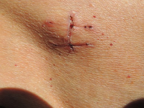Cicatrice ernia inguinale