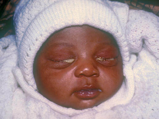 Congiuntivite gonococcica