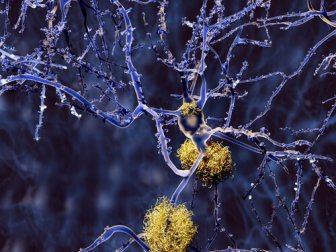 Tipi di demenza diversi dall'Alzheimer