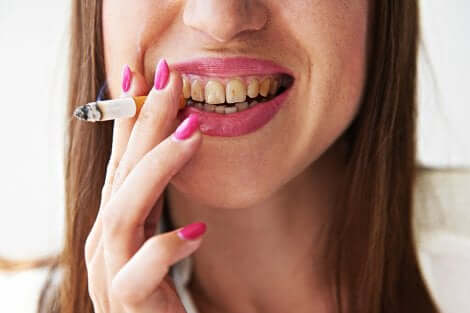Tumore alla lingua: donna fumatrice.