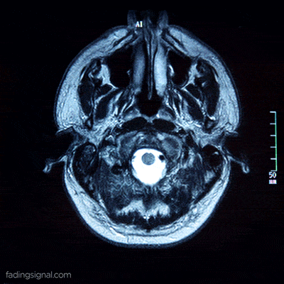Gif di una tac al cervello