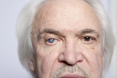 Paziente anziano con glaucoma