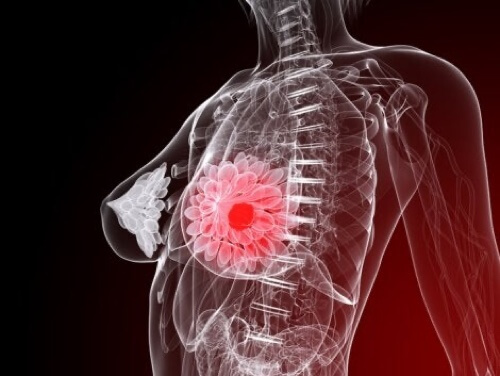 Tipi di tumore alla mammella