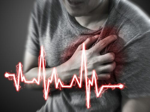 Infarto del miocardio