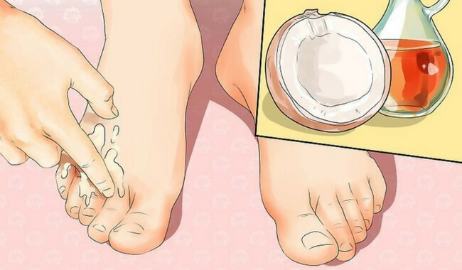 Escrescenze sui piedi: 4 rimedi naturali Escrescenze sui piedi: 4 rimedi naturali