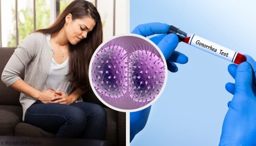 Che cos'è la gonorrea?