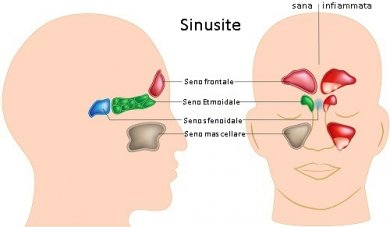 Sinusite: cause, tipi e diagnosi