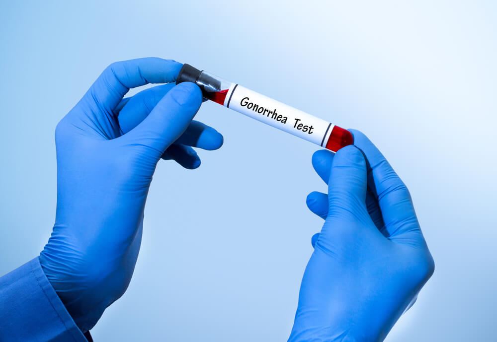 Test per la gonorrea