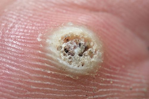 Papilloma vírus 70. genotípusa