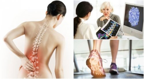 Osteoporosi: 6 dati da conoscere