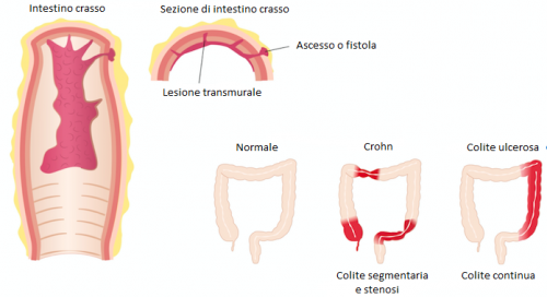 Morbi di Crohn