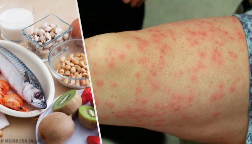 alimenti allergizzanti e braccio con allergia