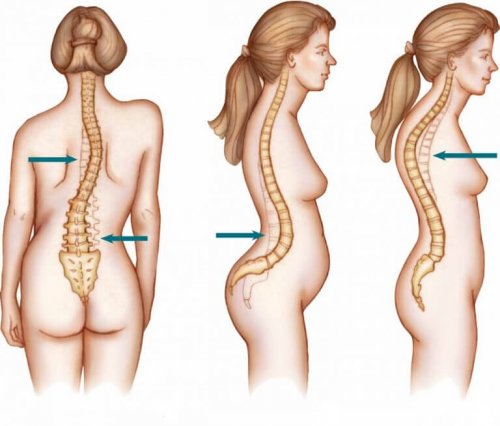La scoliosi nelle donne